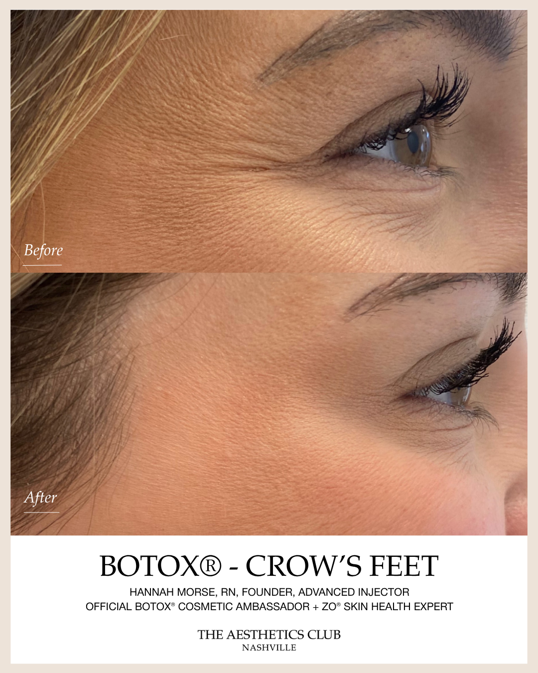 Before and after Crow’s feet Botox treatment by Hannah Morse Cuffman RN at The Aesthetics Club Nashville, Crow’s feet · Client 1